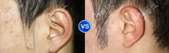 鬢角種植前后對比圖 鬢角種植前后對比圖