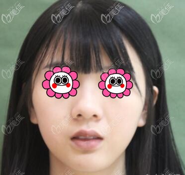 做厚唇改薄術前照 做厚唇改薄術前照