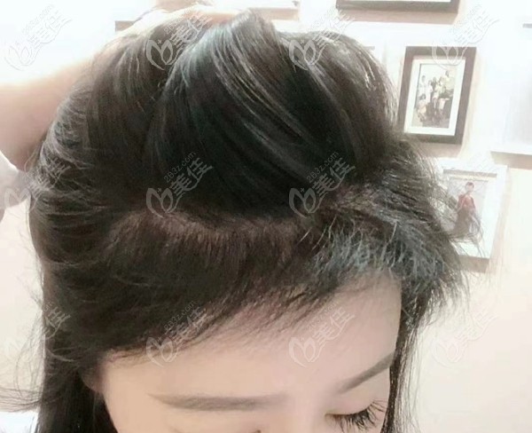 深圳鵬程發(fā)際線植發(fā)6個月效果圖 深圳鵬程發(fā)際線植發(fā)6個月效果圖