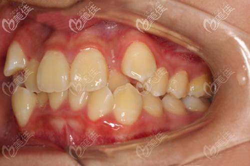 牙列擁擠矯正前的照片 牙列擁擠矯正前的照片
