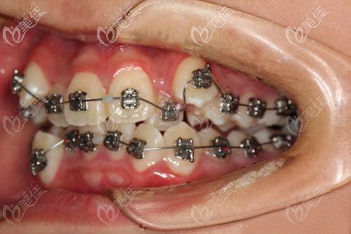 戴金屬自鎖托槽矯正牙齒擁擠 戴金屬自鎖托槽矯正牙齒擁擠