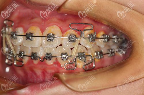 武漢牙達(dá)人口腔醫(yī)院漢陽(yáng)店正畸案例：矯治牙列擁擠只用了14個(gè)月