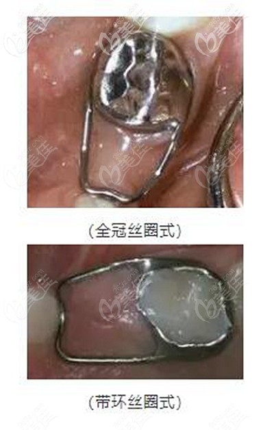 牙齒間隙保持器的不同類型