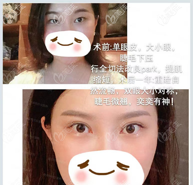 廣州趙成利割雙眼皮口碑好是因為趙成利雙眼皮修復(fù)技術(shù)好
