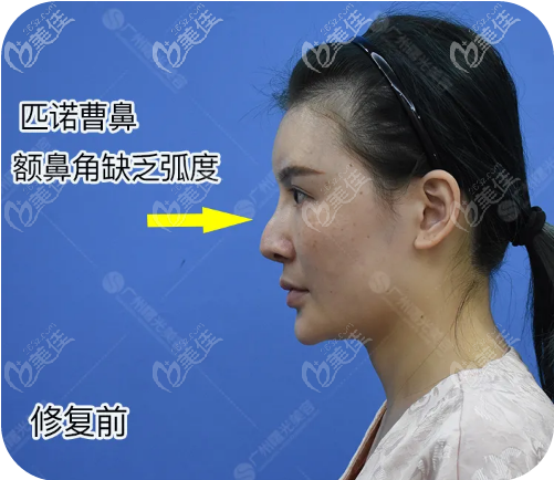 分享我第三次隆鼻成功親身經歷