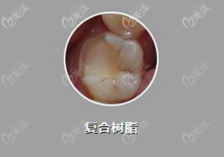 復(fù)合樹(shù)脂補(bǔ)牙的價(jià)格