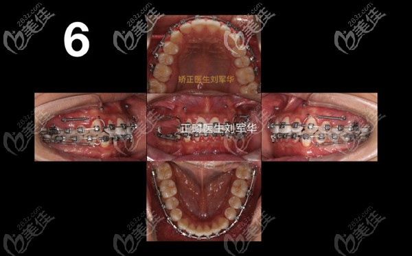 金屬自鎖托槽矯正<span style= 金屬自鎖托槽矯正<span style=