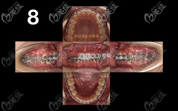 支抗釘前移上頜效果 支抗釘前移上頜效果