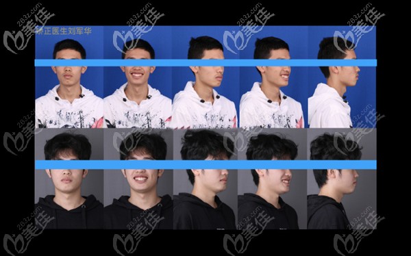 矯正前后效果對比 矯正前后效果對比