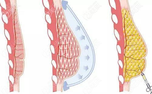 玻尿酸豐胸效果