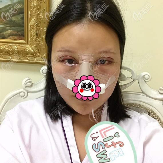 雙眼皮修復(fù)術(shù)后即刻 雙眼皮修復(fù)術(shù)后即刻