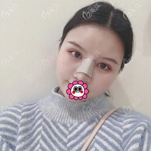 雙眼皮修復(fù)術(shù)后12天 雙眼皮修復(fù)術(shù)后12天