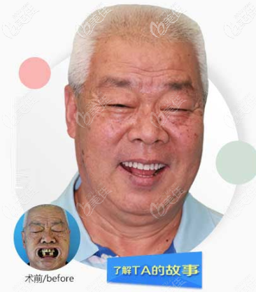 貴陽華美紫馨口腔全口種植牙效果圖