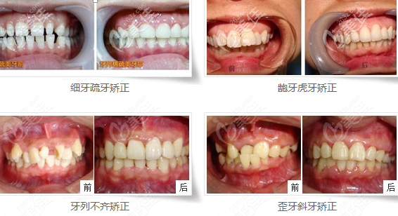 貴陽華美口腔齙牙/牙齒不齊矯正效果圖