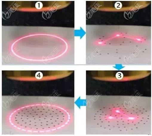 江陰時(shí)光激光祛斑價(jià)格年底有調(diào)整，在1月22日直播間里還有優(yōu)惠福利
