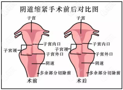 陰道縮緊動畫圖
