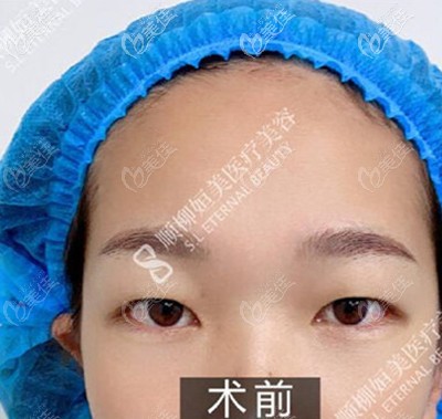 雙眼皮術(shù)前 雙眼皮術(shù)前