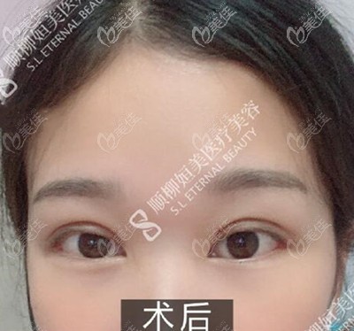 雙眼皮術(shù)后半個月恢復(fù)效果 雙眼皮術(shù)后半個月恢復(fù)效果