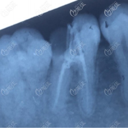 補(bǔ)牙前的牙齒狀態(tài)