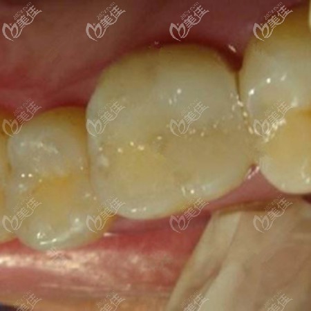 花500多用3mz350樹脂補一顆牙后來給大家說說它的優(yōu)缺點
