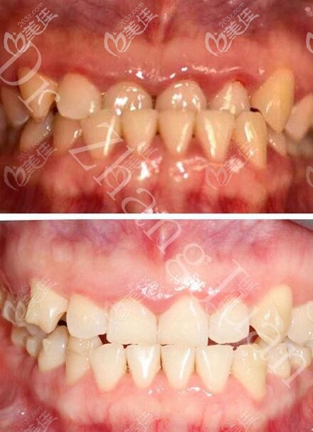 地包天隱適美隱形矯正三個月太贊,價格再貴都值,感謝深圳馬瀧齒科張娟醫(yī)生