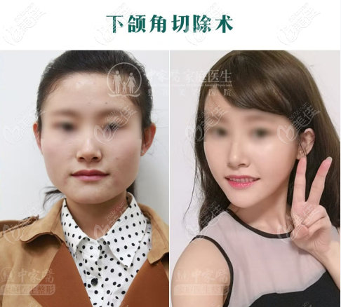 廣州中家醫(yī)家庭醫(yī)生聶云飛下頜角磨骨<span style=