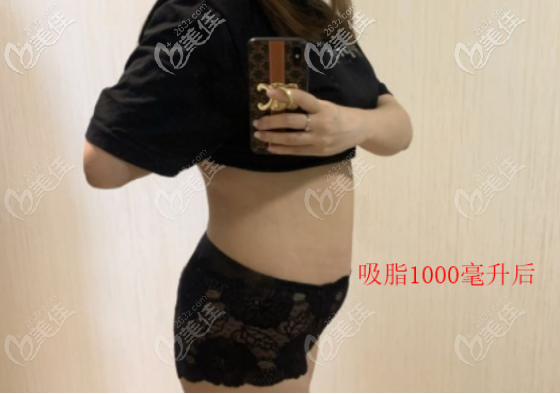 初次腰腹吸脂術(shù)后照片
