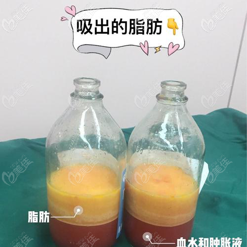 初次腰腹吸脂沒(méi)有效果和變化，二次腰腹吸脂2000毫升能瘦3斤