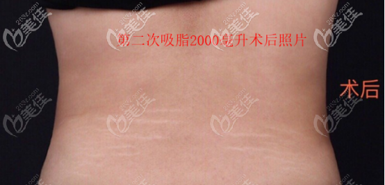 第二次吸脂后的照片