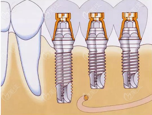 種植牙使用壽命