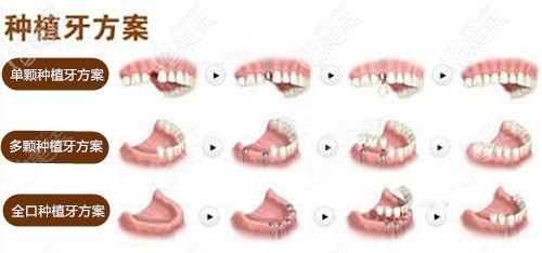 種植牙設(shè)計方案