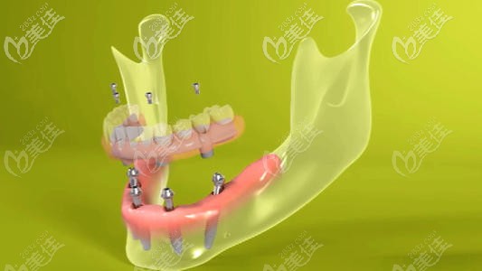 alllon4半口/全口種植牙