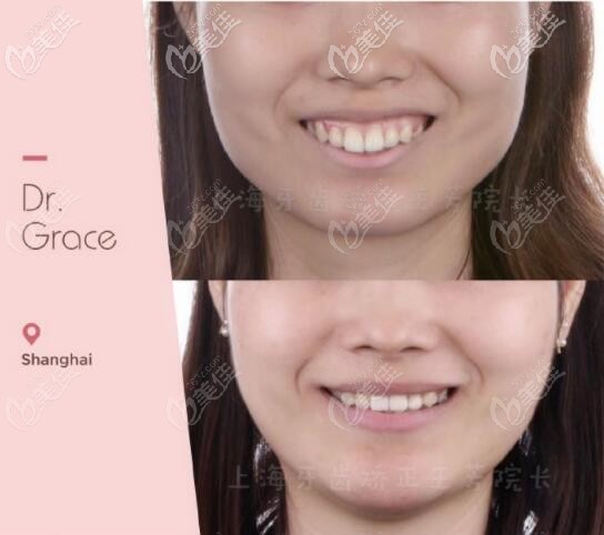 講述我的重度骨性齙牙+露齦笑戴隱適美牙套矯正的案例，沒做正頜手術(shù)只是因?yàn)檎覍?duì)了醫(yī)生
