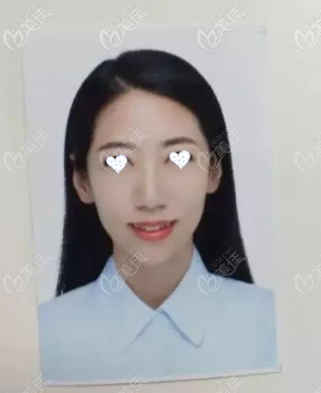 隱適美牙套矯正5個月效果圖