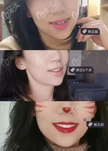 戴隱形牙套6-16個月變化圖