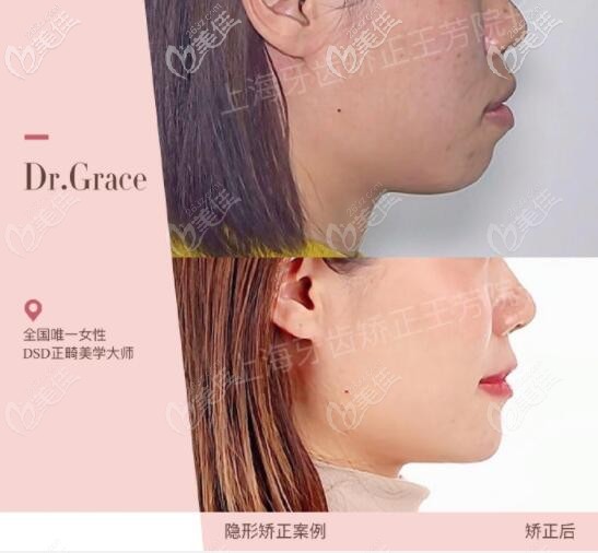 王芳院長做過的骨性嘴巴前凸矯正<span style=