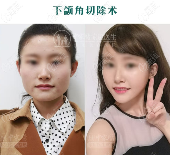 下頜角<span style=