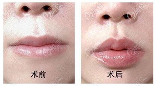 玻尿酸豐唇縮短人中效果對比 玻尿酸豐唇縮短人中效果對比
