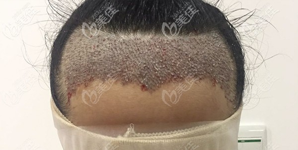 廣州天姿發(fā)際線種植術(shù)后即刻效果