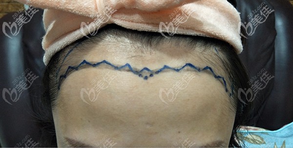 跟醫(yī)生協(xié)商后設(shè)計(jì)的發(fā)際線形狀