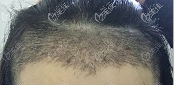 女生發(fā)際線越來越高怎么辦？她選擇在廣州天姿種發(fā)際線讓額頭縮窄3厘米