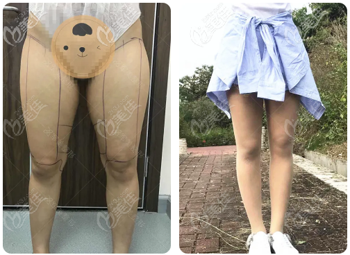 做腿部吸脂術大約多少錢？我做大腿抽脂肪花了14800多元