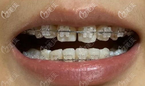 陶瓷半隱形牙套