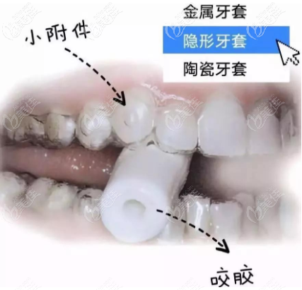 隱形牙套咬膠使用圖示