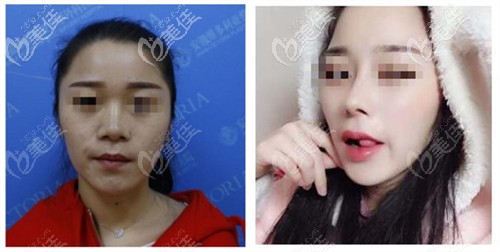 合肥維多利亞衛(wèi)愛俠隆鼻案例