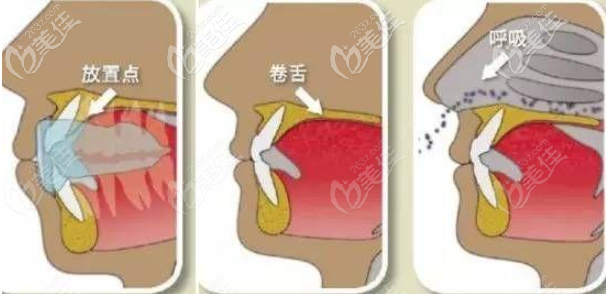 MRC牙齒矯正示意圖