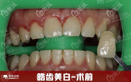 在博美口腔做皓齒美白前