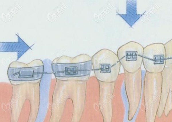 輕微牙齒歪斜做矯正療程也較短
