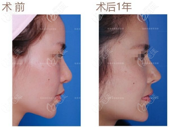 通過鼻修復看歐陽春鼻子做的怎么樣