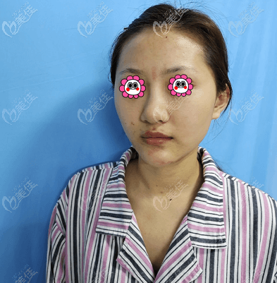 我做肋骨鼻綜合前 我做肋骨鼻綜合前